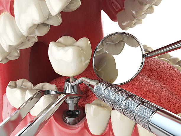 Best Emergency Tooth Extraction in South Point, OH